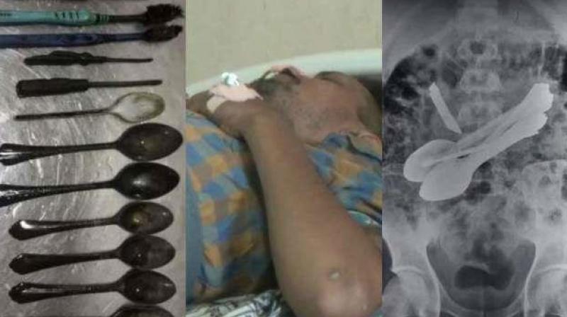 Doctors take out toothbrushes knives spoons etc from man's stomach