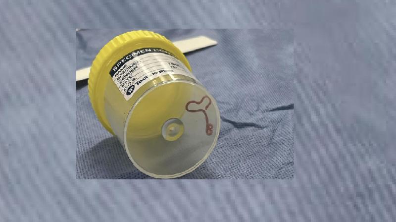 Parasite in a specimen jar. Parasite in a specimen jar.