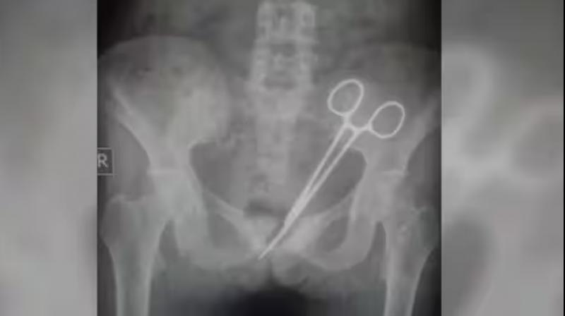 Scissors lying in the woman's stomach for 12 years Scissors lying in the woman's stomach for 12 years