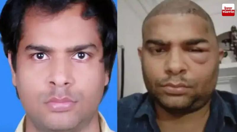 Another engineer dies after hair transplant in Kanpur Latest News in Punjabi Another engineer dies after hair transplant in Kanpur Latest News in Punjabi