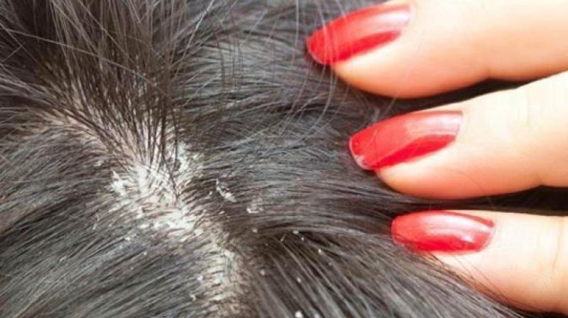 Dandruff Dandruff