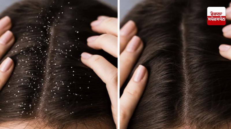 Follow these home remedies to get rid of dandruff in winter Follow these home remedies to get rid of dandruff in winter