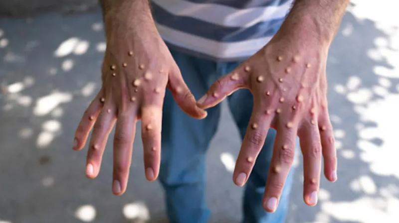 Ampox virus reached Pakistan Ampox virus reached Pakistan