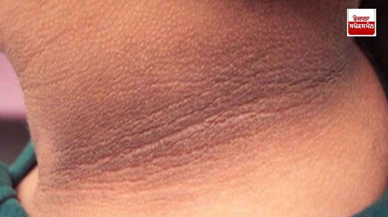 If your neck has turned black then try this recipe If your neck has turned black then try this recipe