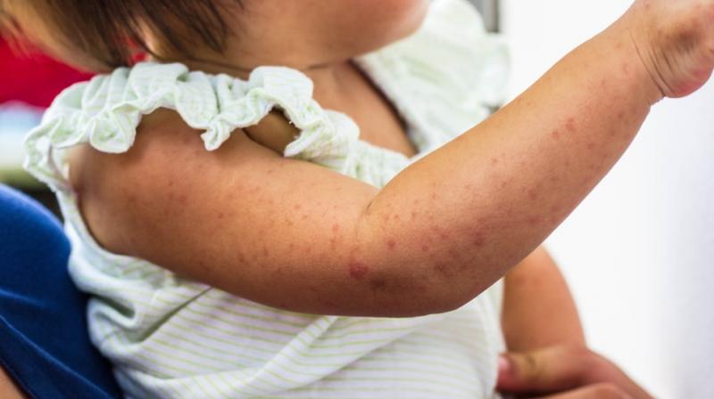 The measles outbreak is widespread in New Zealand