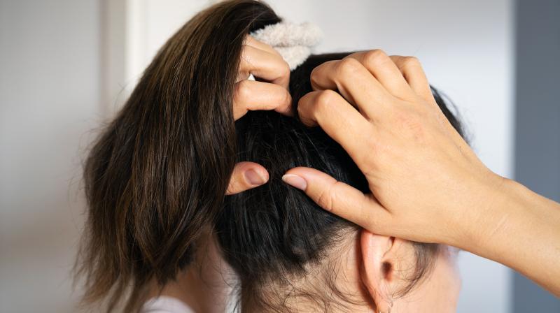 Home remedies to treat itchy scalp Home remedies to treat itchy scalp