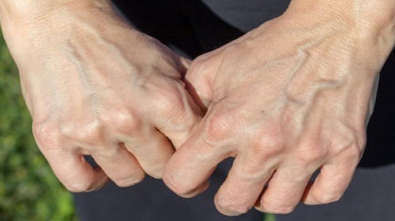 Appearance of veins in body Appearance of veins in body