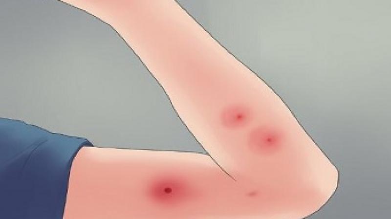 Infection Infection