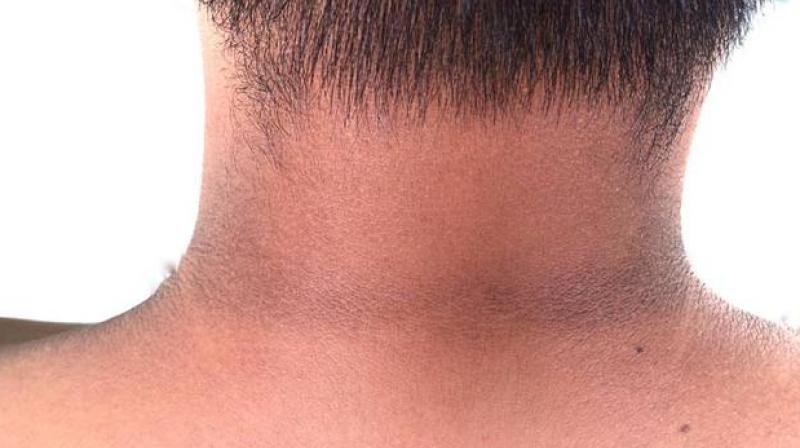 Neck Blackness Neck Blackness