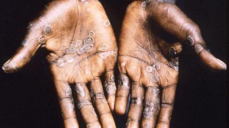 The first case of Mankind's virus came in front The first case of Mankind's virus came in front