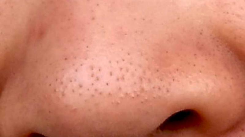 Get rid of Blackheads Get rid of Blackheads