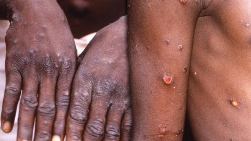Alert issued for mock pox in Himachal News Alert issued for mock pox in Himachal News