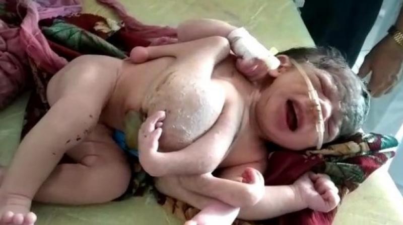 Four legged girl born in Rajasthan Four legged girl born in Rajasthan