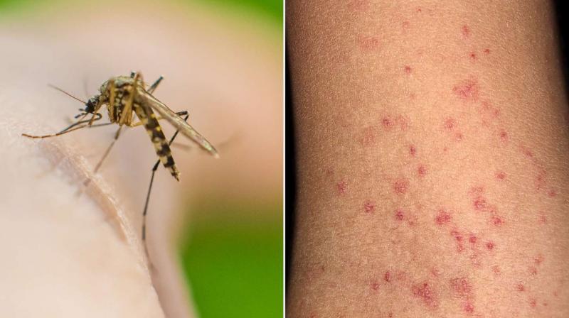 Health News: Risk of dengue Health News: Risk of dengue