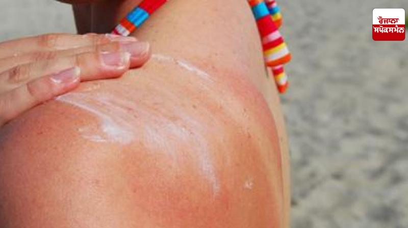 Home remedies for sun-tanned skin Home remedies for sun-tanned skin