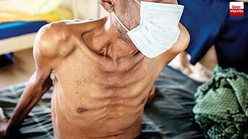 The number of TB patients increased in india News