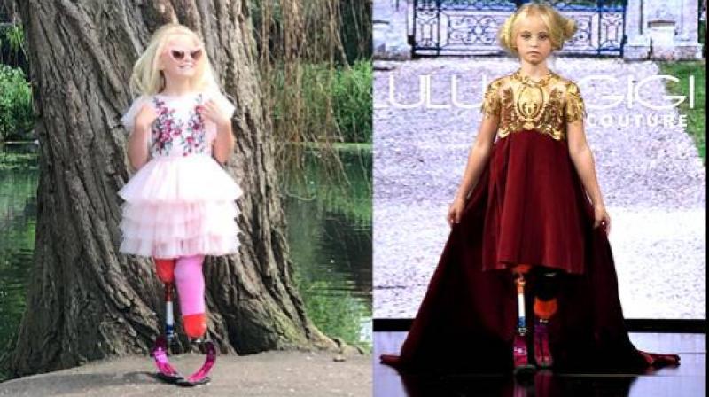 Girl lost both legs rare disease walk new york fashion week