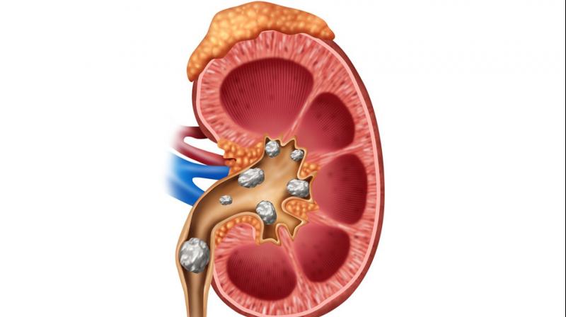 wrong lifestyle creates stony stones in the human body wrong lifestyle creates stony stones in the human body