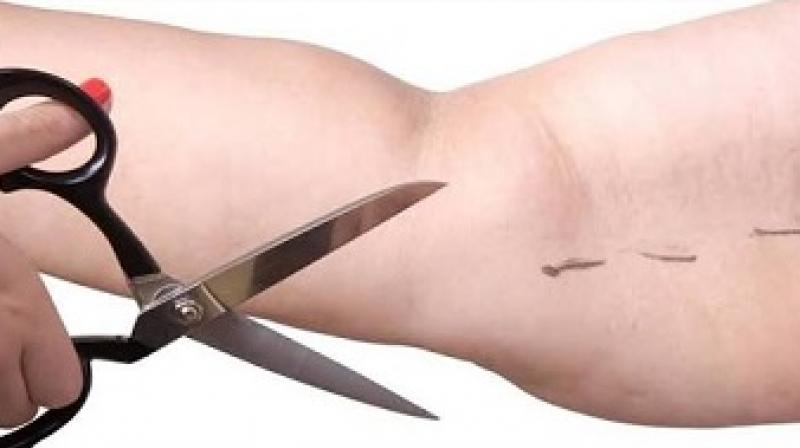 cellulite cellulite