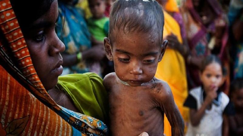 Malnutrition Malnutrition