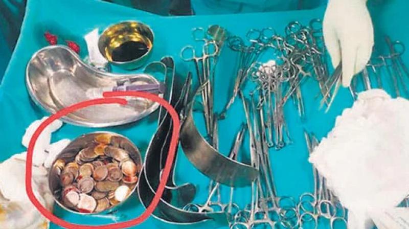 Bagalkot: Doctors remove 187 coins from man’s stomach Bagalkot: Doctors remove 187 coins from man’s stomach