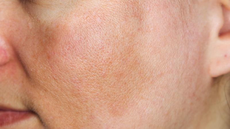 white spots white spots