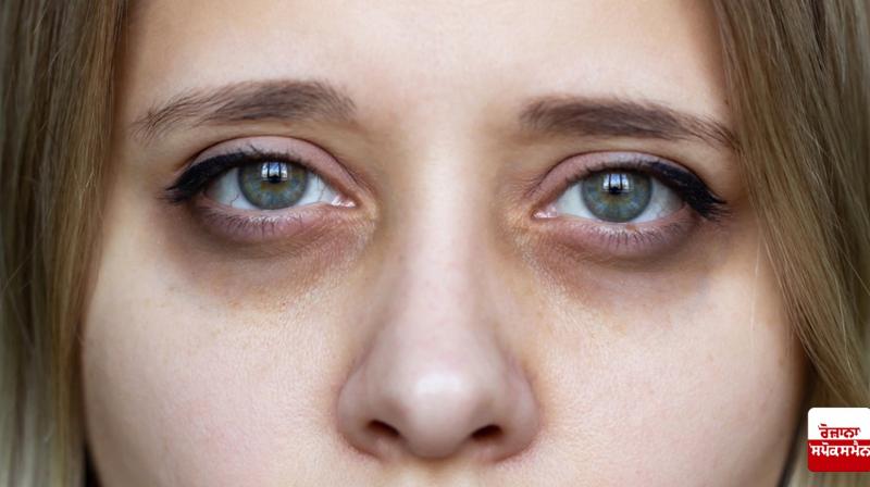 Get rid of dark circles under your eyes in a week Beauty Tips Get rid of dark circles under your eyes in a week Beauty Tips