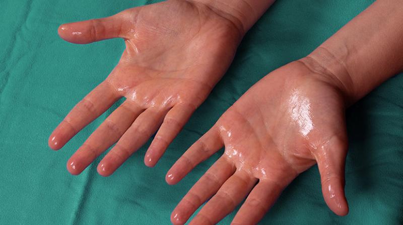 Sweating of hands and feet Health News