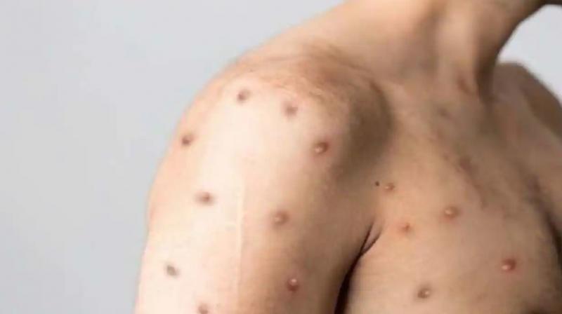 BREAKING: First MONKEY POX case reported in Kolkata? BREAKING: First MONKEY POX case reported in Kolkata?