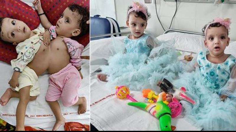 UP Conjoined Twins Separated After Successful Surgery By AIIMS-Delhi Doctors UP Conjoined Twins Separated After Successful Surgery By AIIMS-Delhi Doctors