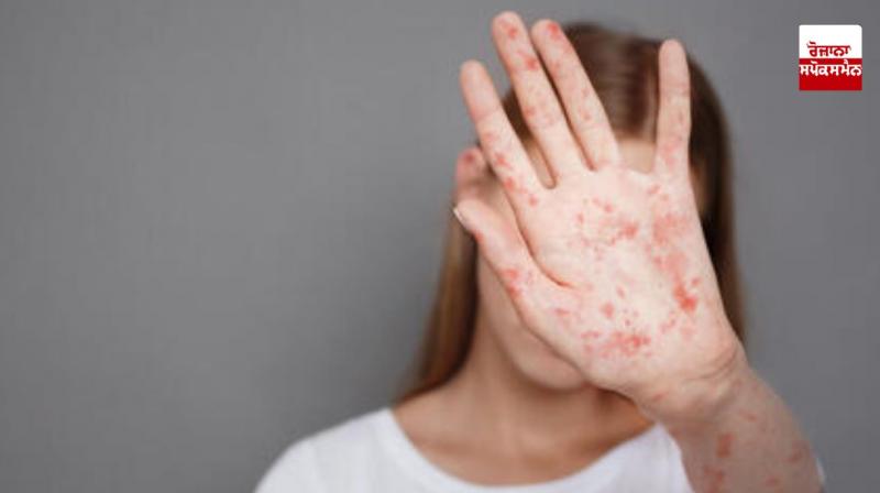 America Measles Disease News America Measles Disease News