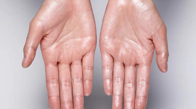 If you are suffering from sweating of hands and feet then treat it like this If you are suffering from sweating of hands and feet then treat it like this