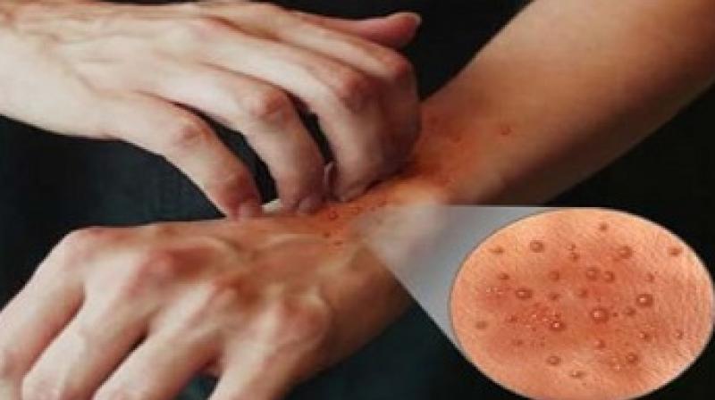 eczema eczema