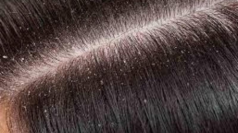 Dandruff treatment household tips