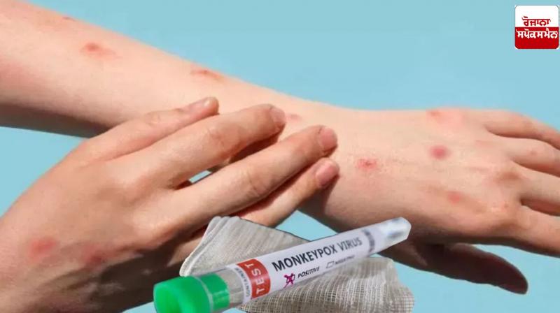 Another case of Mockpox found in India Another case of Mockpox found in India