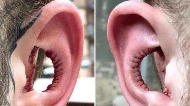 He got his earlobes removed to hear more He got his earlobes removed to hear more