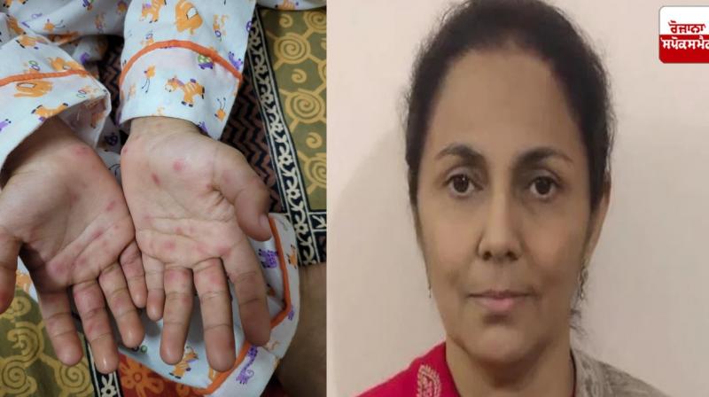 Mohali Civil Surgeon statement on suspected case of Monkeypox Mohali Civil Surgeon statement on suspected case of Monkeypox
