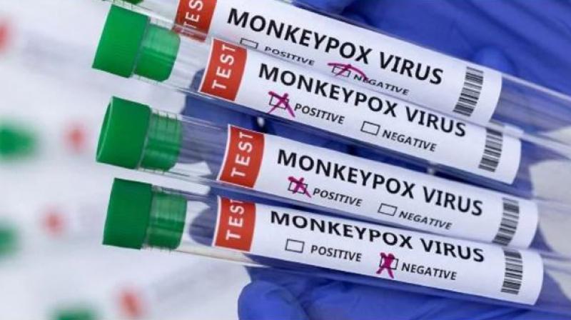 Second Monkeypox case confirmed Second Monkeypox case confirmed