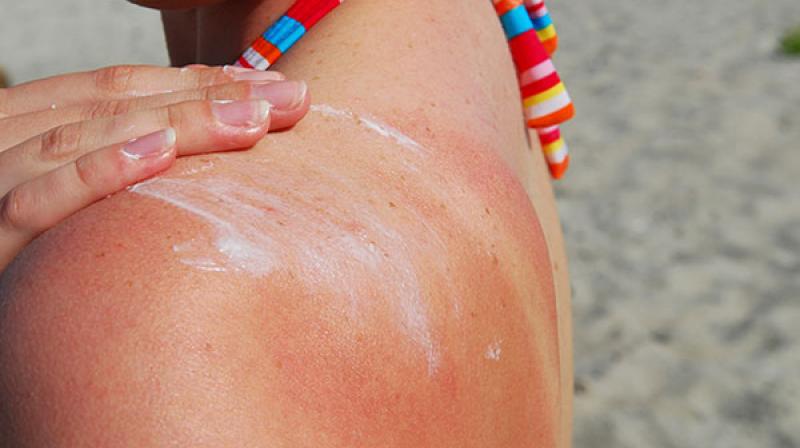 Treat Sunburn at Home