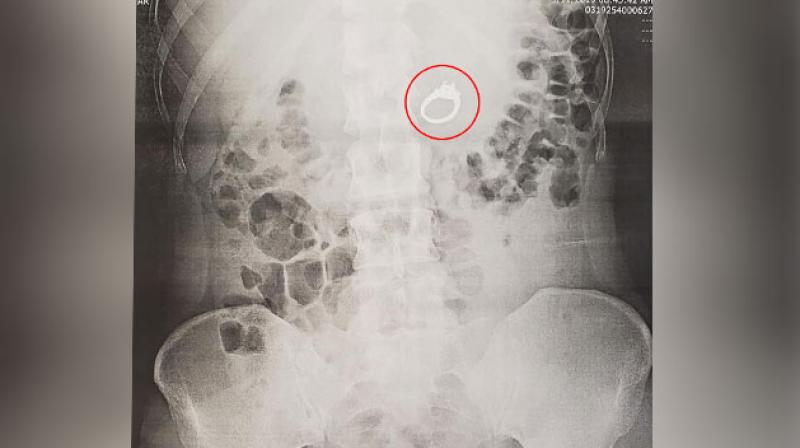 Woman dreamed she swallowed her engagement ring. She actually swallowed it in her sleep.