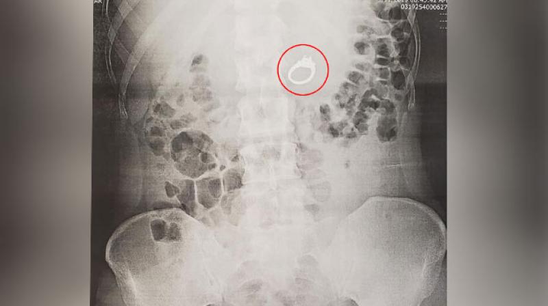 Woman dreamed she swallowed her engagement ring. She actually swallowed it in her sleep. Woman dreamed she swallowed her engagement ring. She actually swallowed it in her sleep.