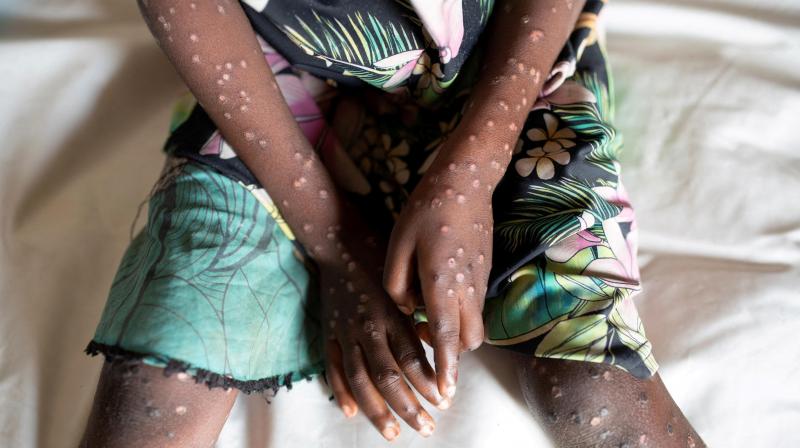 Mpox Virus spread in 100 countries Mpox Virus spread in 100 countries