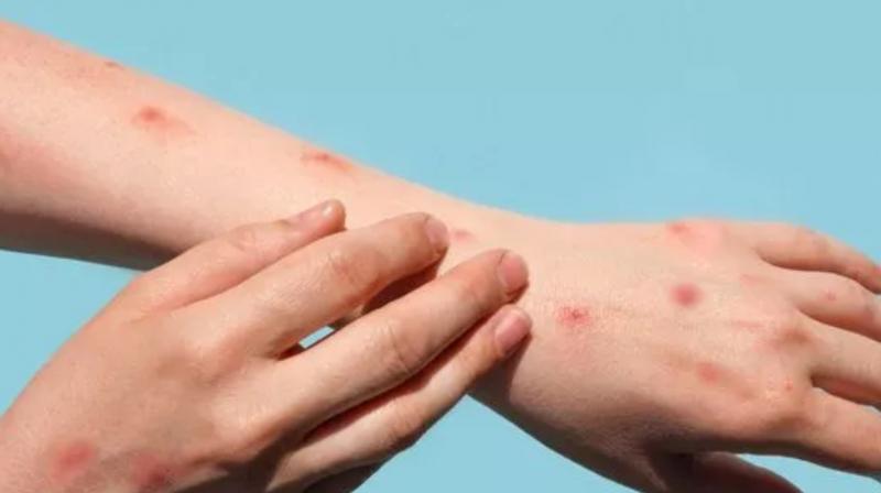 Know how monkeypox virus spreads, symptoms and treatment Know how monkeypox virus spreads, symptoms and treatment