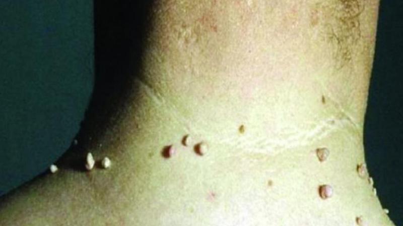 People suffering from the problem of moles can get relief with these home remedies Health News People suffering from the problem of moles can get relief with these home remedies Health News