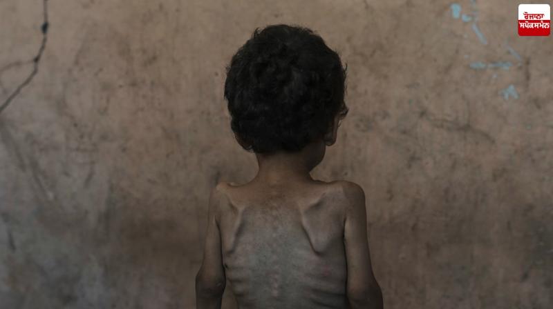 55,000 young children in Gaza suffer from severe malnutrition UN News 55,000 young children in Gaza suffer from severe malnutrition UN News