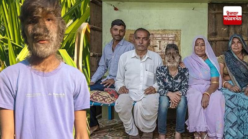 MP: Teenage Boy Diagnosed With Rare Werewolf Syndrome Has Hair Growing All Over His Body MP: Teenage Boy Diagnosed With Rare Werewolf Syndrome Has Hair Growing All Over His Body