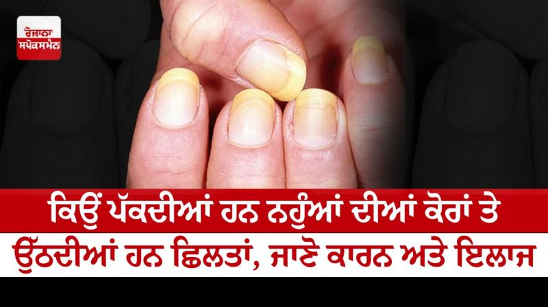 Why do the nails grow on the cores, know the causes and treatment Why do the nails grow on the cores, know the causes and treatment