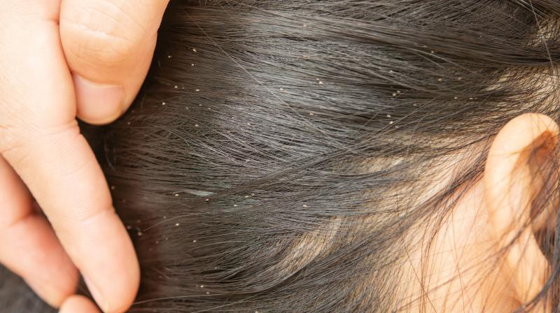 Head lice Head lice