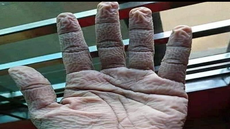 Hand After Wearing Gloves for 10 Hours Goes Viral Hand After Wearing Gloves for 10 Hours Goes Viral