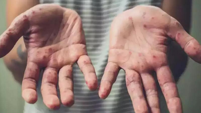 Monkeypox will prove dangerous for children, AIIMS expert warned Monkeypox will prove dangerous for children, AIIMS expert warned